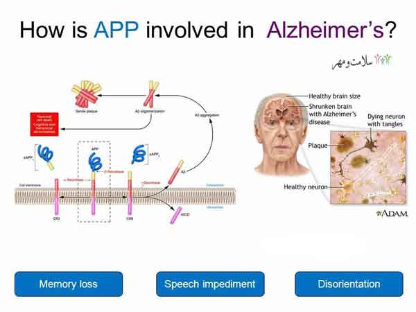 کشف جدید دانشمندان برای درمان آلزایمر ناشی از سندرم داون