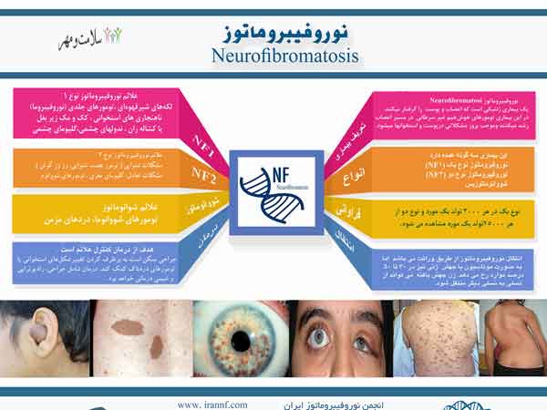ثبت بیش از 26 هزار مبتلا به بیماری نادر ژنتیکی در ایران( Neurofibromatosis یا رشد و گشترش تومور ، بر روی اعصاب محیطی بدن )