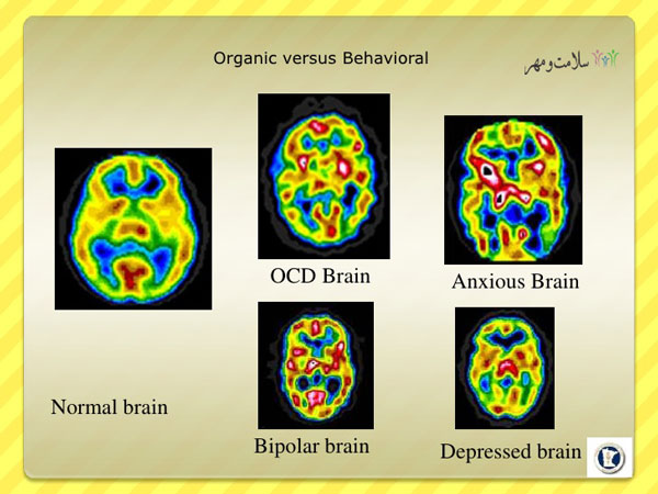 سفر به درون مغز افراد دچار انواع اختلالات روانشناختی 